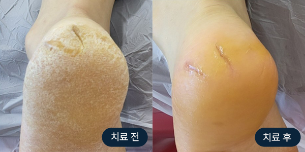 발각질 치료 전/후 사진